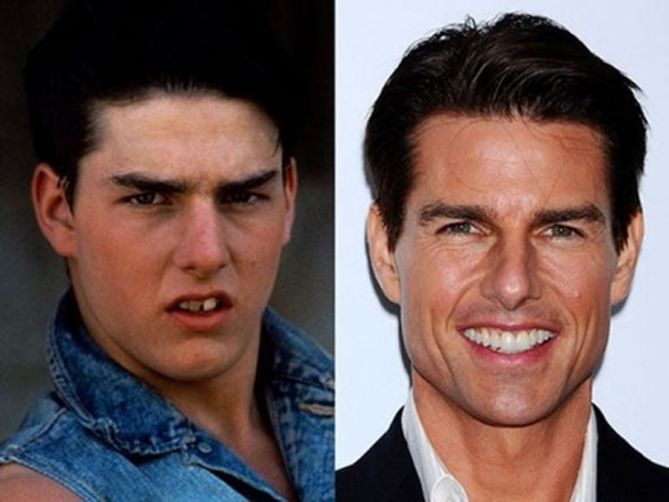 famosos antes y después de operarse los dientes