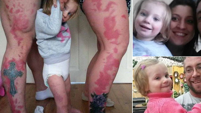 Se tatúan las manchas de nacimiento de su hija para que no se sienta diferente